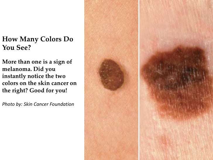 How To Tell If You Have A Skin Cancer Spot
