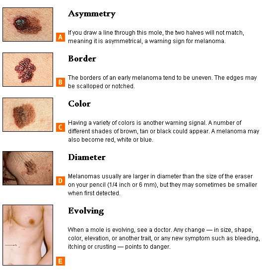 How to tell if you have skin cancer