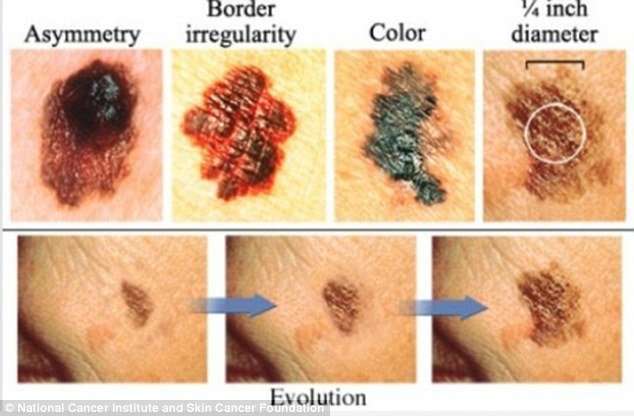 How to tell if YOU have skin cancer from irregular moles ...