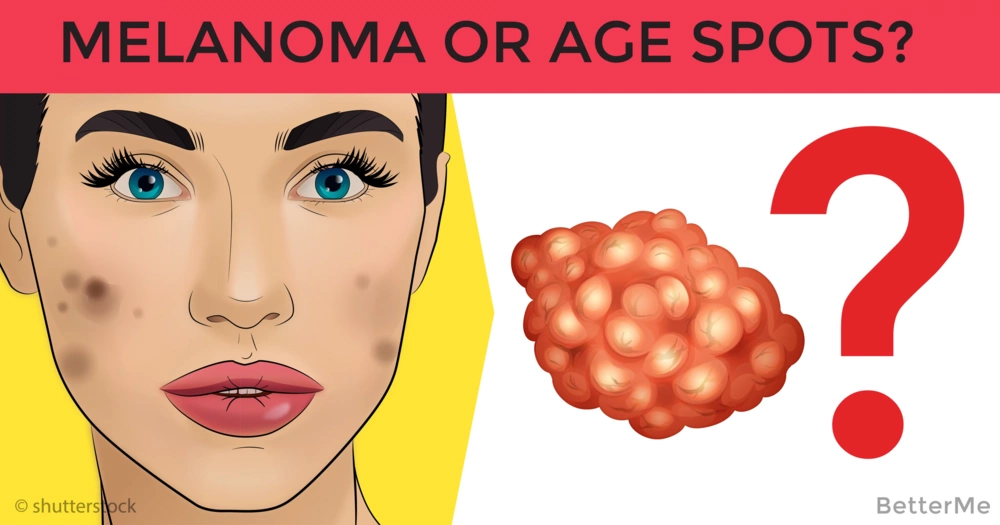 How to tell the difference between age spots and melanoma