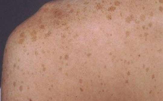 How to tell the difference between age spots or liver ...