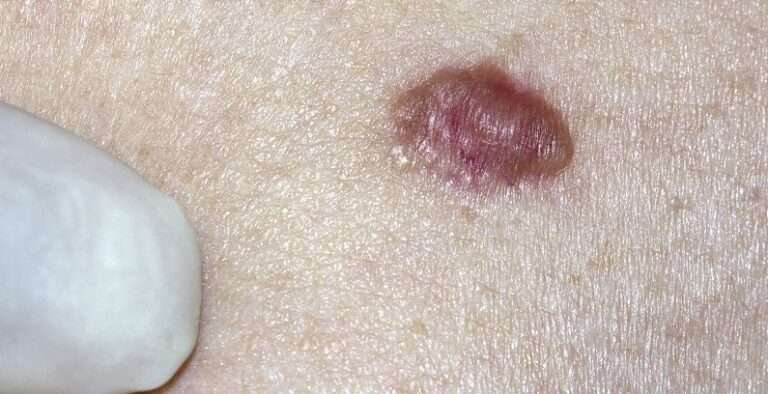 How to Treat Basal Cell Carcinoma