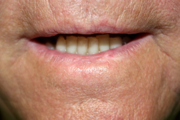 Hpv Bumps On Lips : Human Papilloma Virus Kuta Medical ...