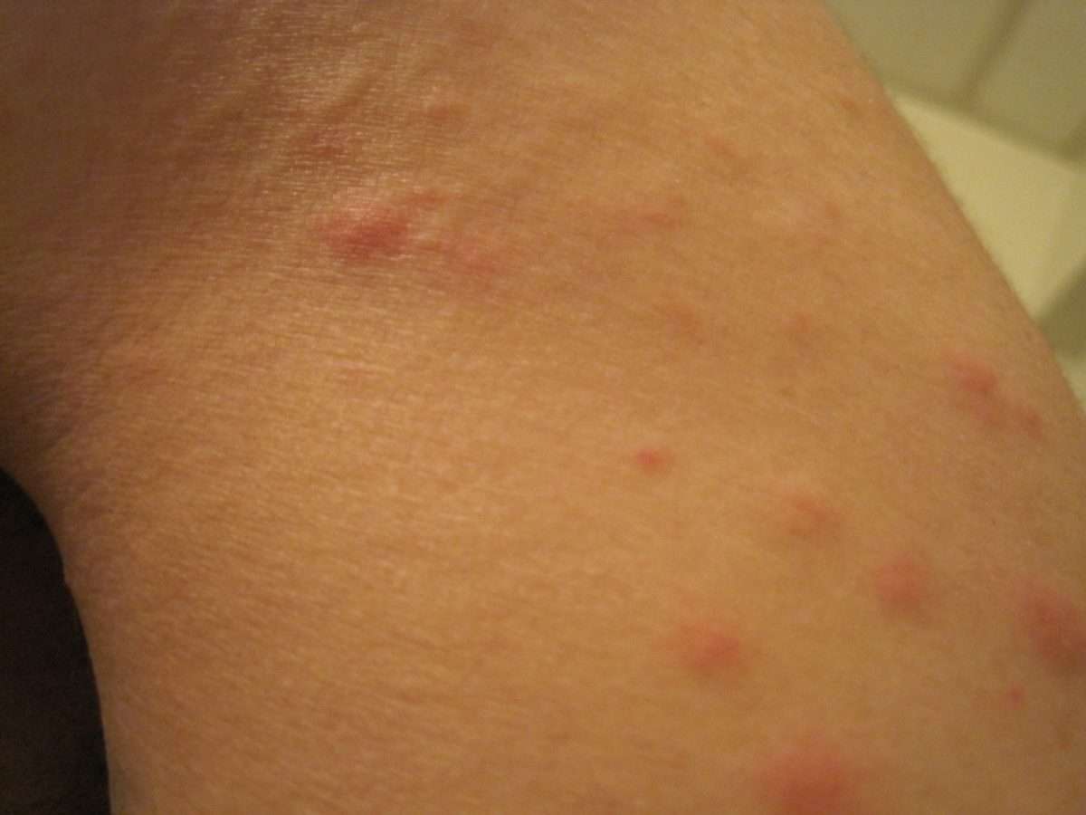 I had a series of red bumps/blotches develop on Monday across