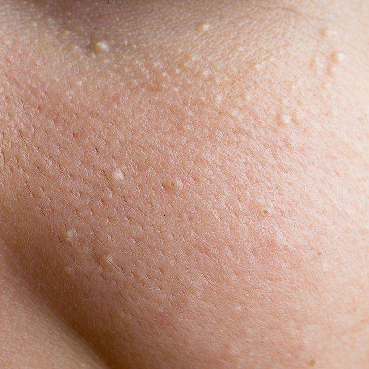 If You See One Of These 12 Bumps On Your Skin, Do Not Pop