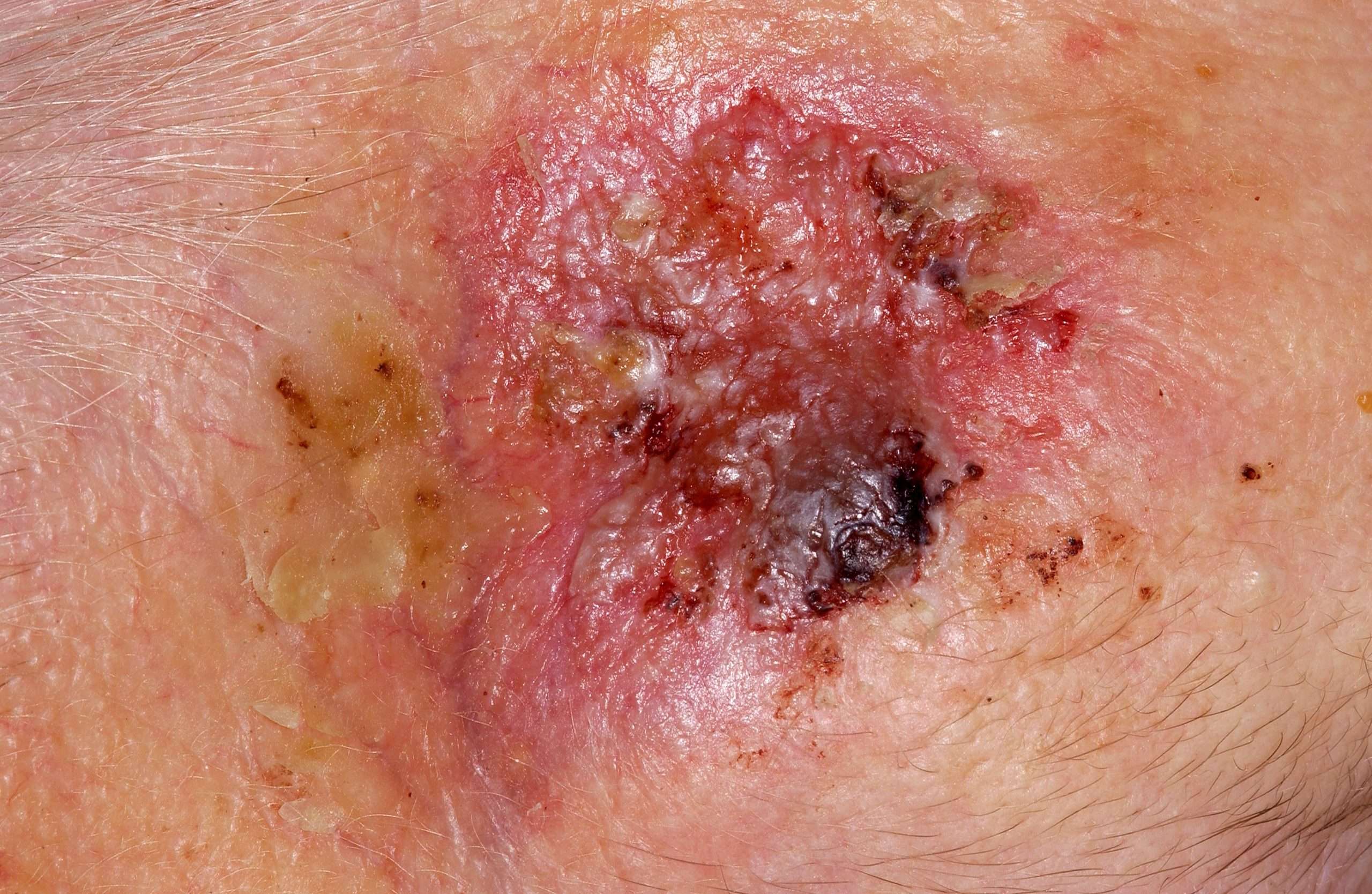 Igarni: Pre Skin Cancer Pictures