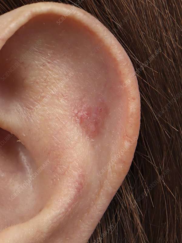 Infiltrating basal cell carcinoma of the ear