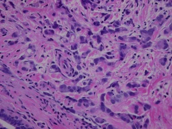 Infiltrating ductal carcinoma of the right breast, Grade 2 ...