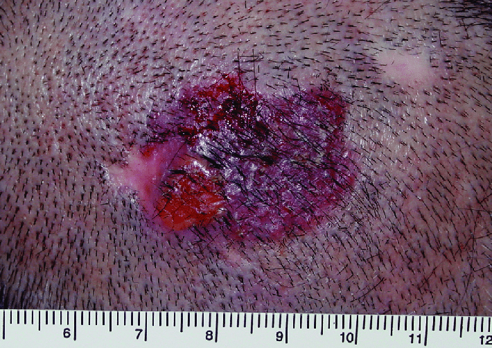 Infiltrative basal cell carcinoma.