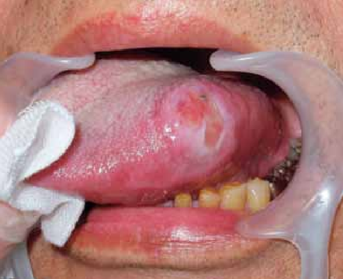 Intraoral view of basaloid squamous cell carcinoma of the ...