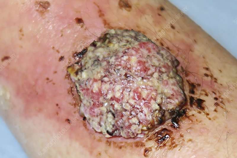 Invasive cutaneous squamous cell carcinoma