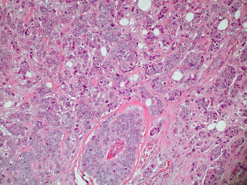 Invasive Ductal Carcinoma (LM)