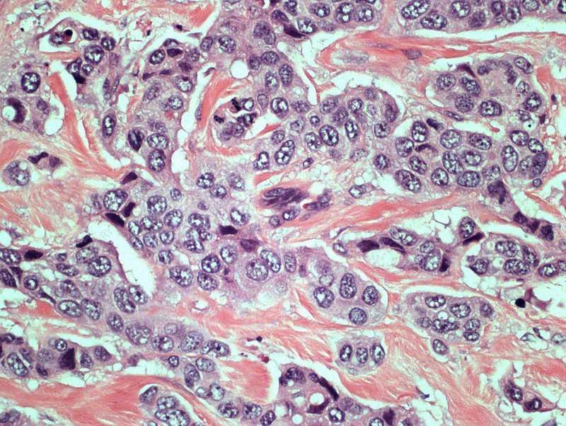 Invasive Ductal Carcinoma, LM