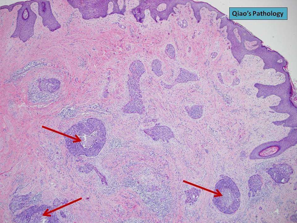Invasive ductal carcinoma of the breast with central ...