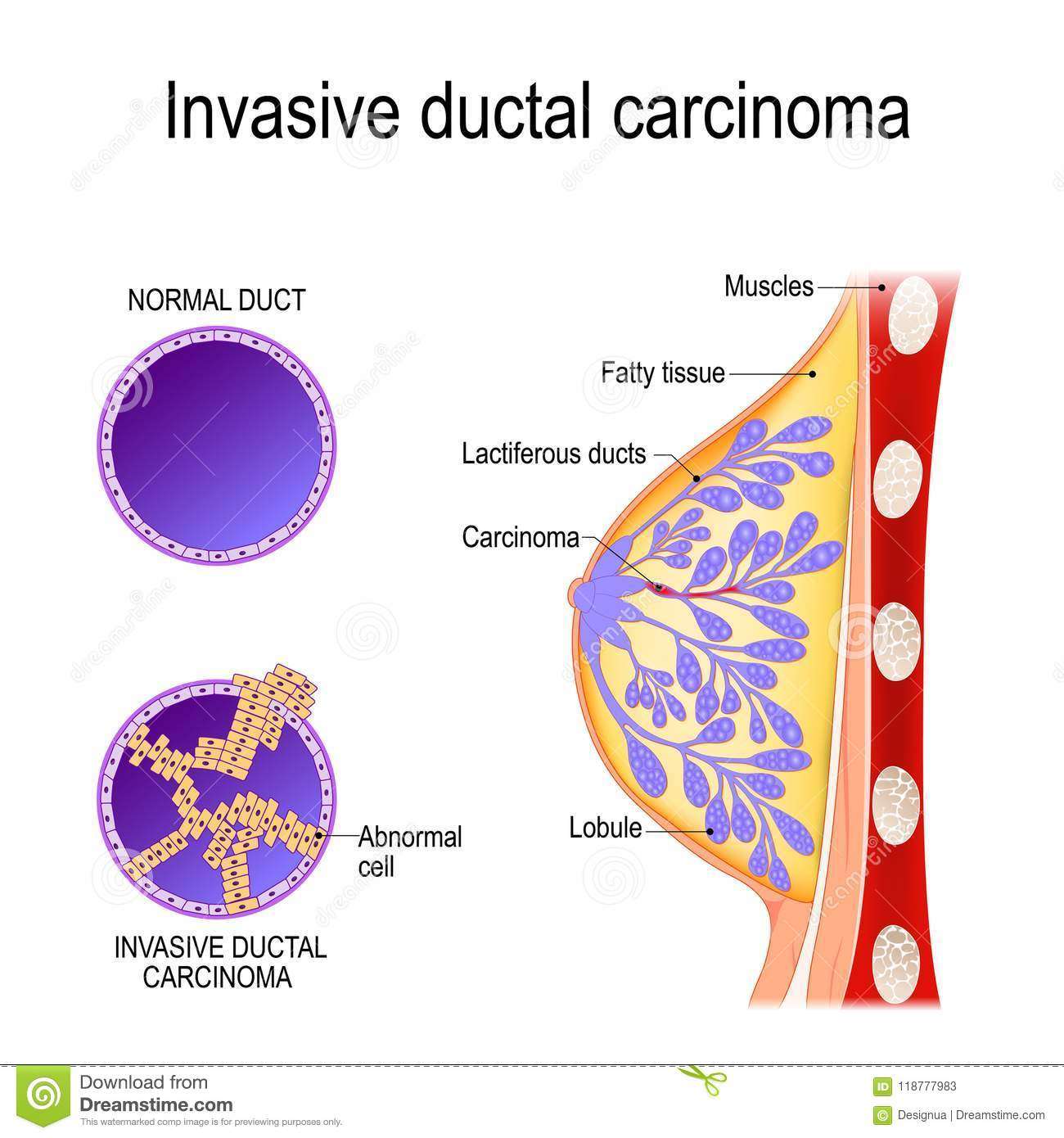 Invasive ductal carcinoma stock vector. Illustration of ...