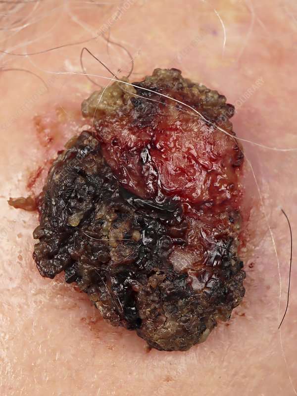 Invasive skin squamous cell carcinoma