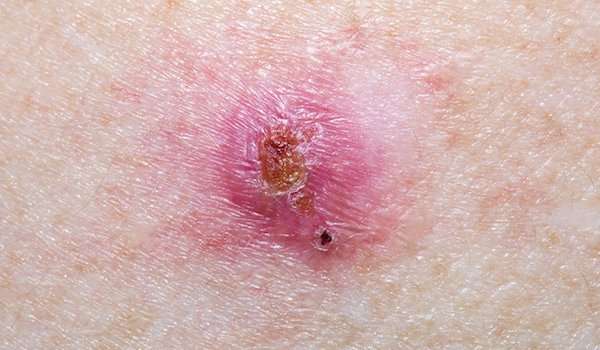 Is Basal Cell Carcinoma Dangerous? (Answer: Yes)
