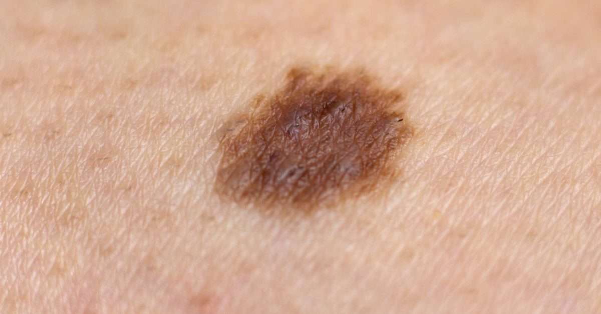 Is it normal for a new mole to appear? Causes and warning ...
