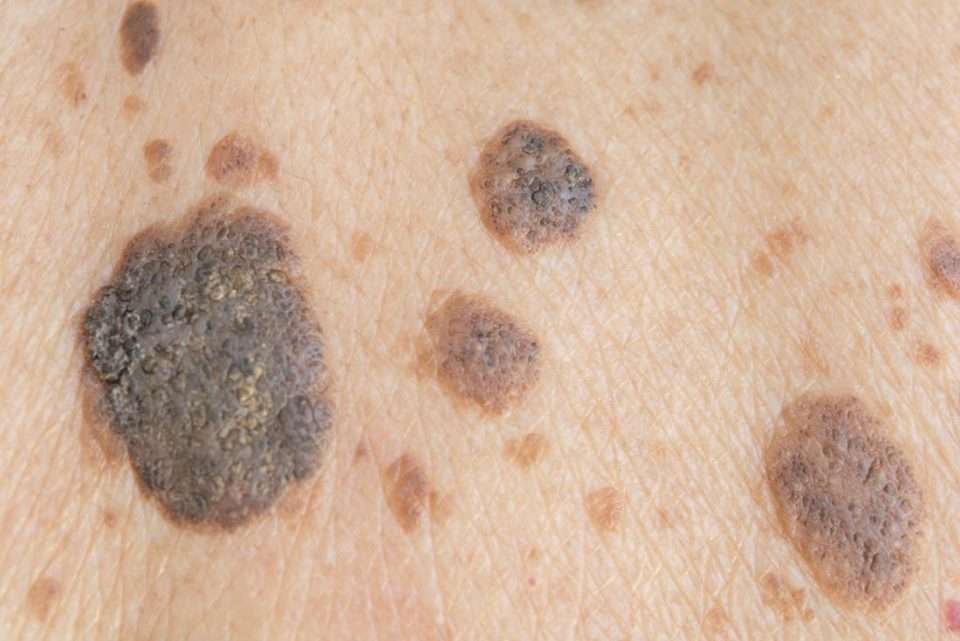 Is it seborrheic keratosis or skin cancer?