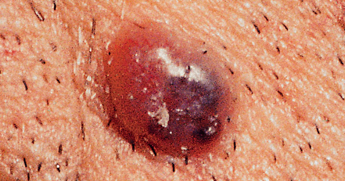 Is it skin cancer? 38 photos that could save your life (PICTURES)