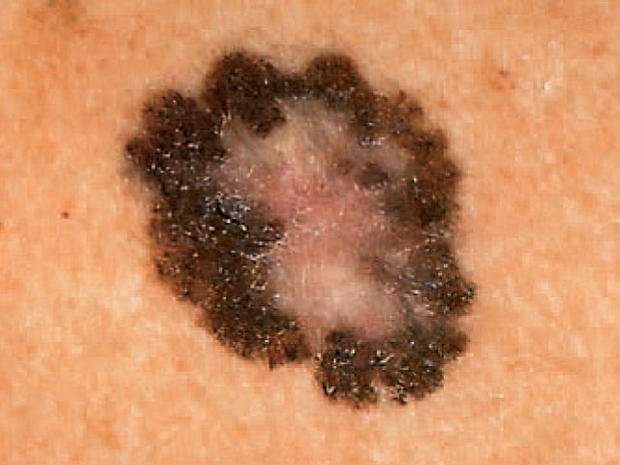 Is it skin cancer?
