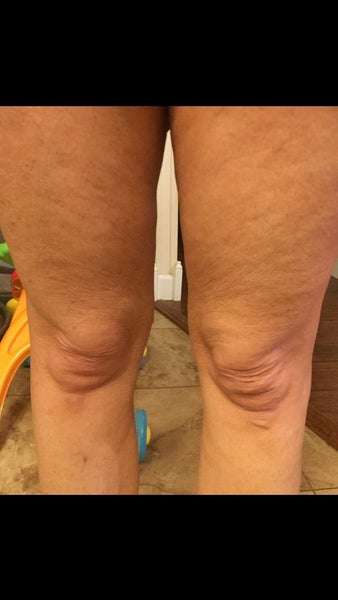 Is there anything that can help loose skin at the knees? (Photo) Doctor ...