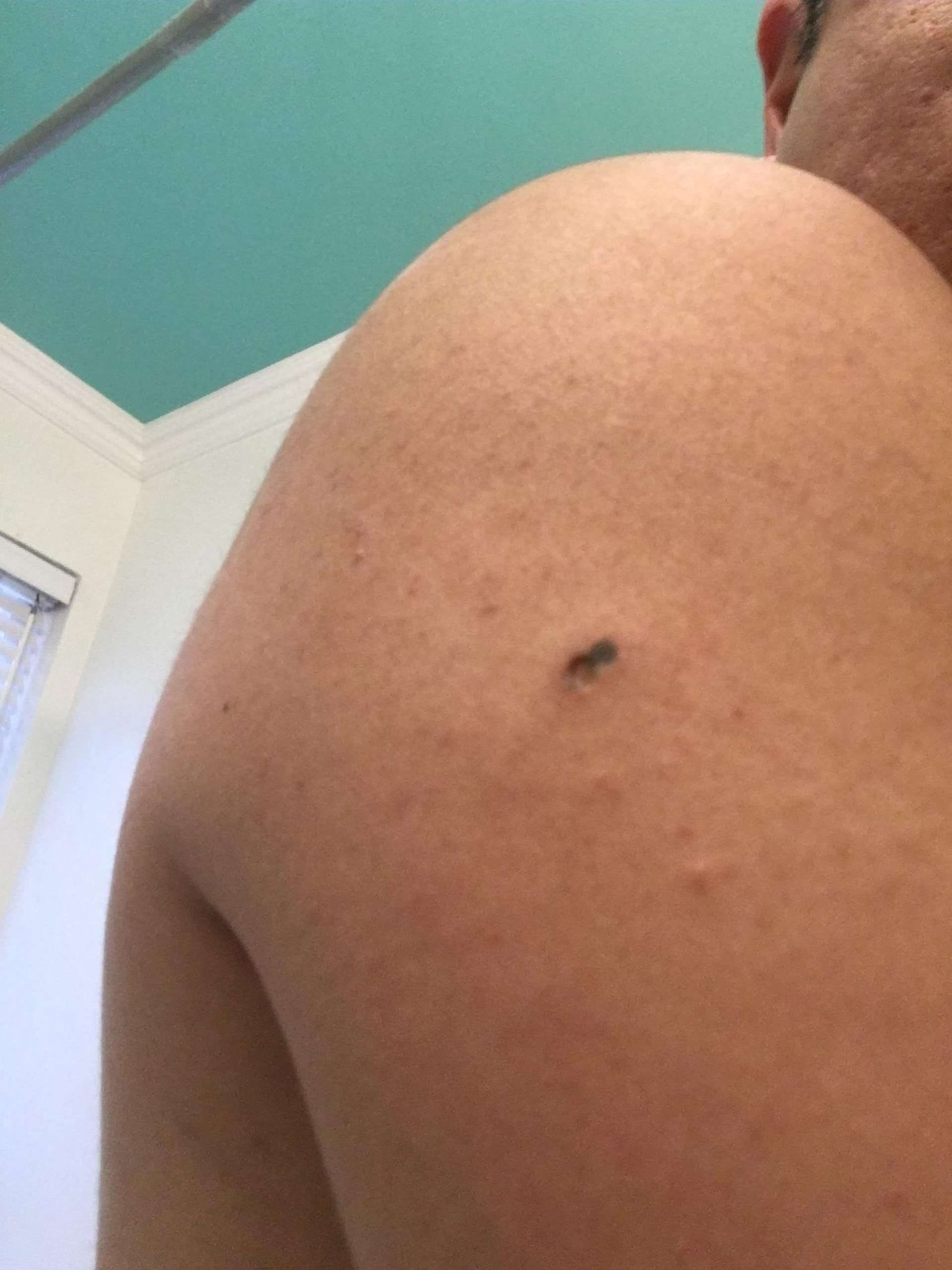 Is this a melanoma? : Dermatology