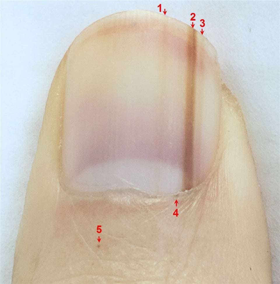 is this melanoma on my nail? : Dermatology