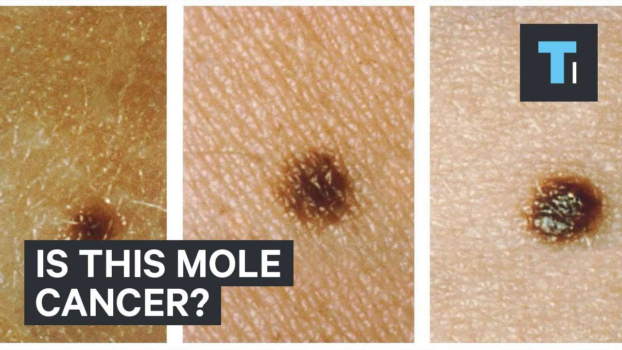Is this mole cancer?