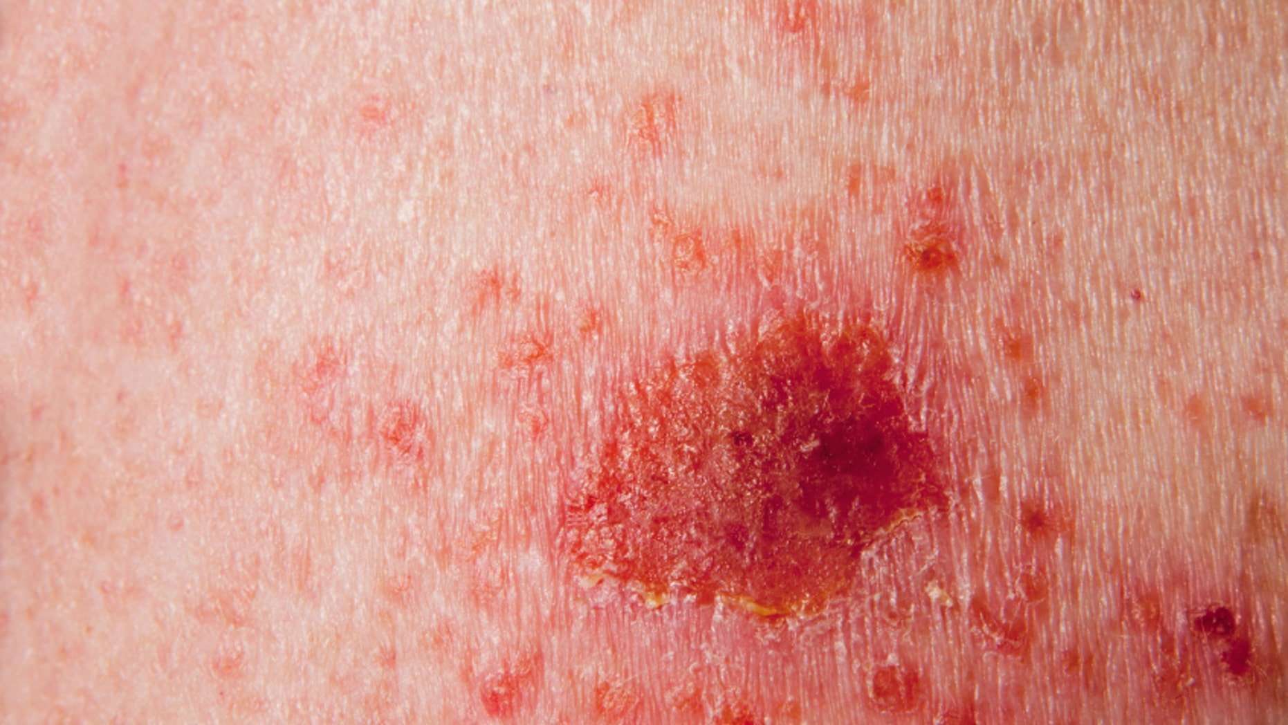 Itching, pain may be indicators of skin cancer