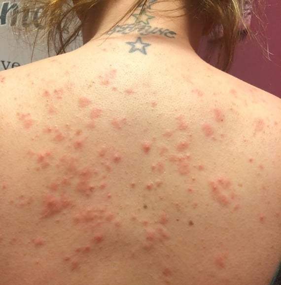 itchy back acne??