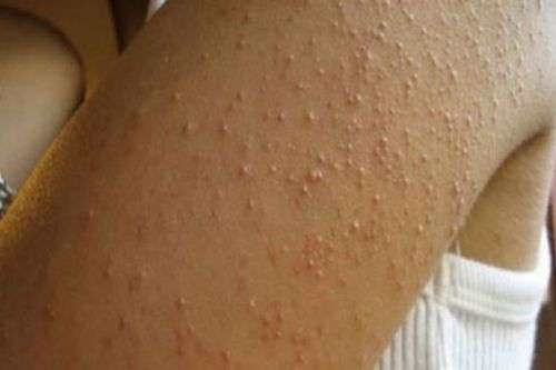 Itchy Bumps All Over Body