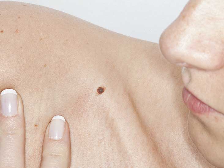 Itchy Mole: Causes, Treatment, Symptoms and More