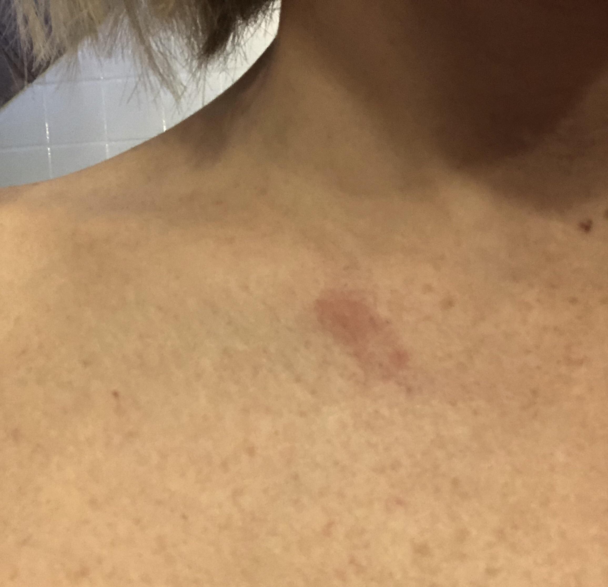 Ive been getting these itchy, inflamed red marks for a few weeks. I ...
