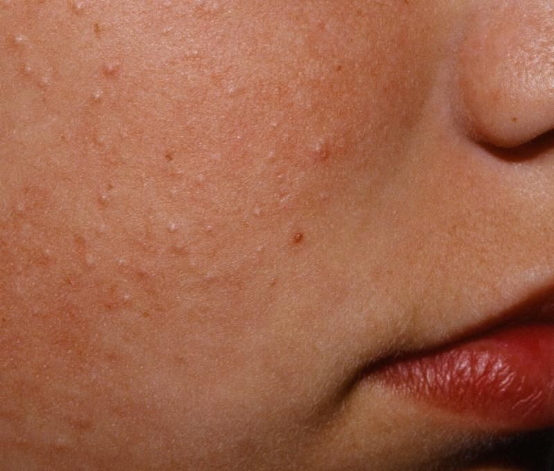 Keratosis Pilaris Tiny Bumps On Face Allergic Reaction