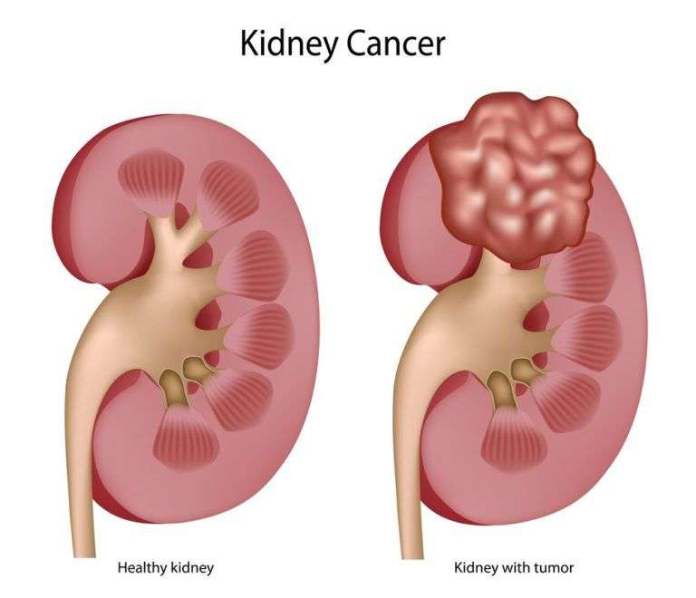 Kidney Cancer » Bradenton, FL