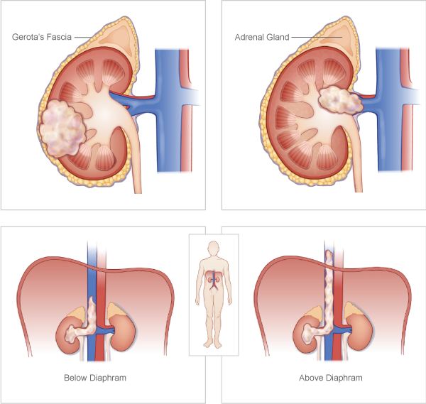 Kidney Cancer Spread To Adrenal Gland