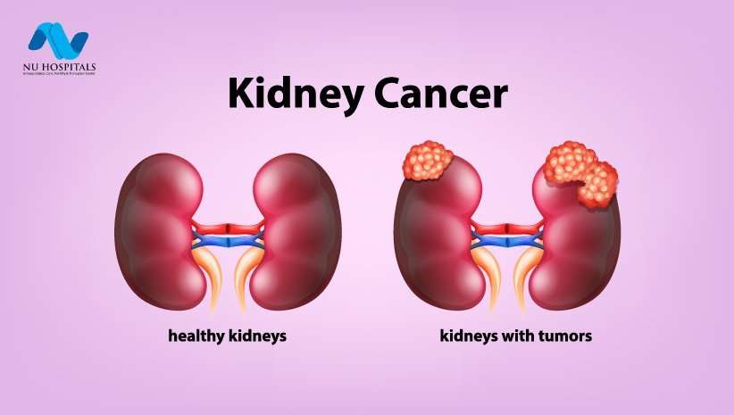 Kidney Cancer: Symptoms,Causes &  Diagnosis Treatment