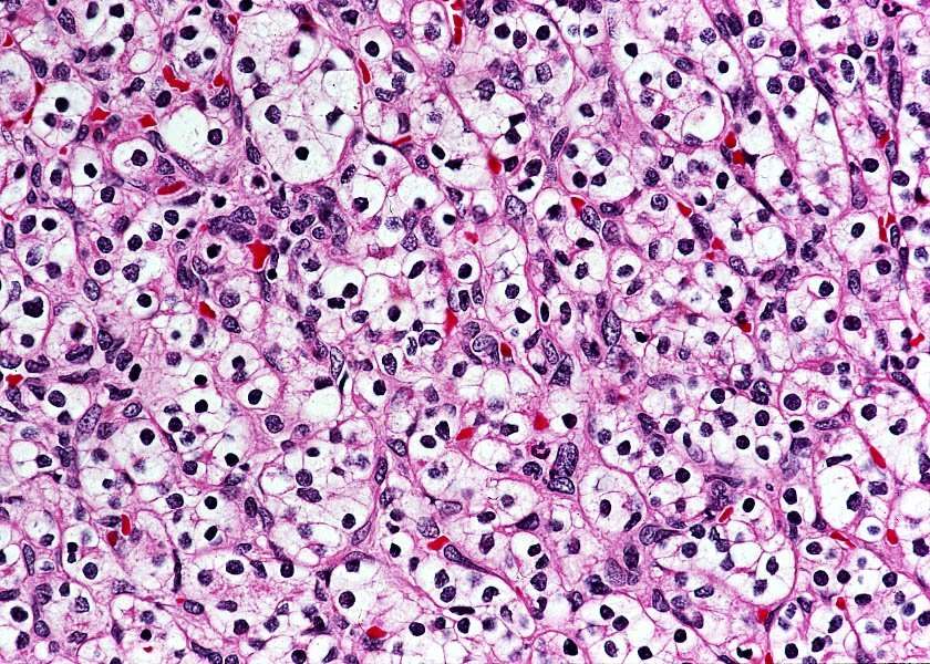 Kidney Clear Cell Renal Cell Carcinoma