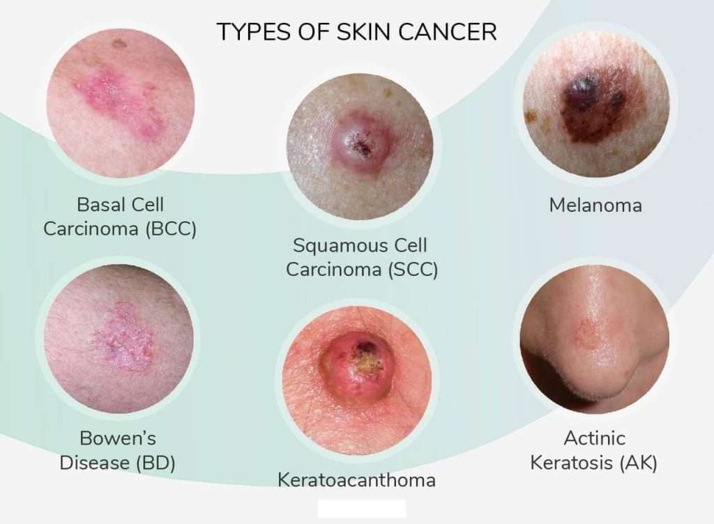 Know Early Signs of Skin Cancer