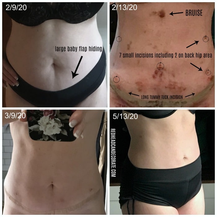 Laser Lipo/Mini Tummy Tuck Journey with Before &  After Photos