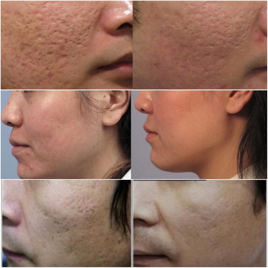 Laser Treatments: An Effective and Safe Solution for Acne Scars