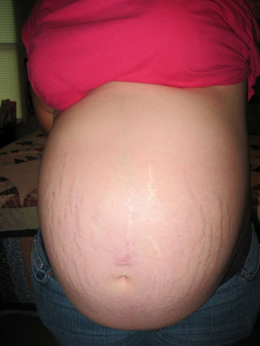 Latest Fashion: How to Prevent Pregnancy Stretch Marks