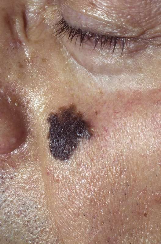 Lentigo maligna melanoma skin cancer