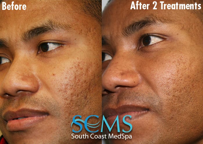 Light and Dark Skin Laser Acne Scar Removal, Asian Skin, Orange County ...
