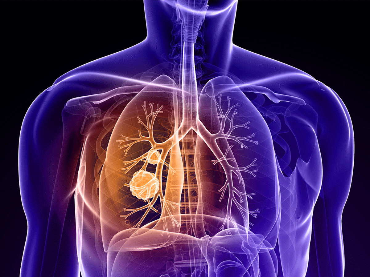 Lipid metabolism controls lung cancer metastasis, not just diseases ...