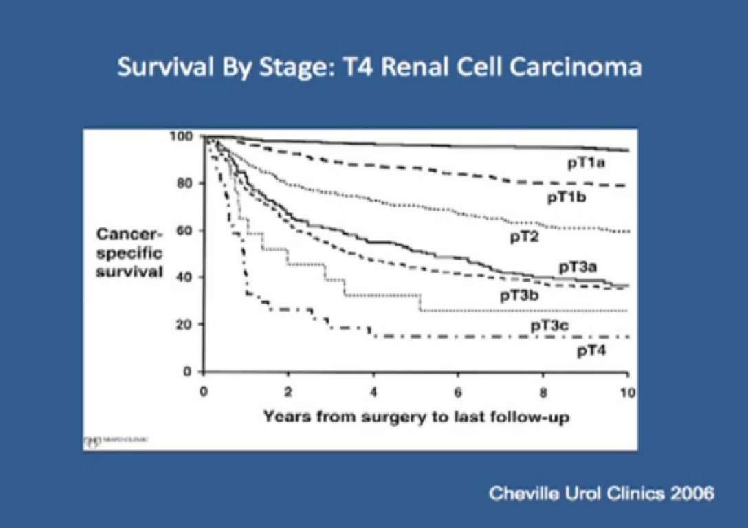 Locally Advanced Renal Cell Carcinoma; Dr. Chris Woods ...