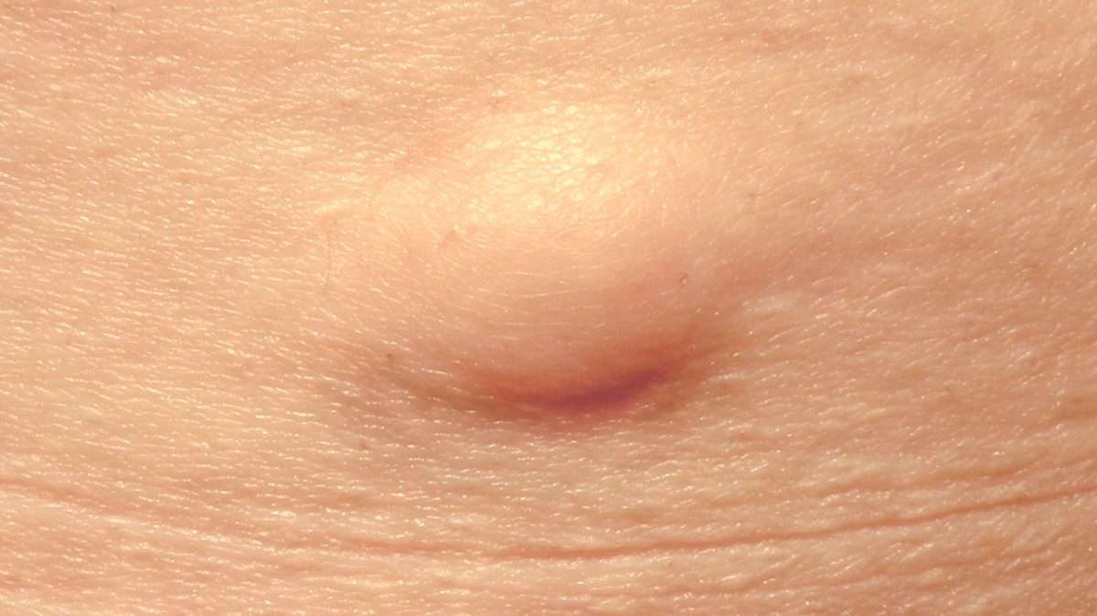 Lumps and Bumps Removal