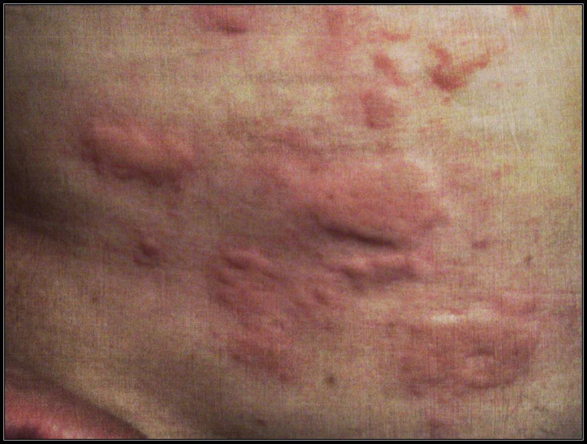 Lung Cancer Skin Rash Pictures