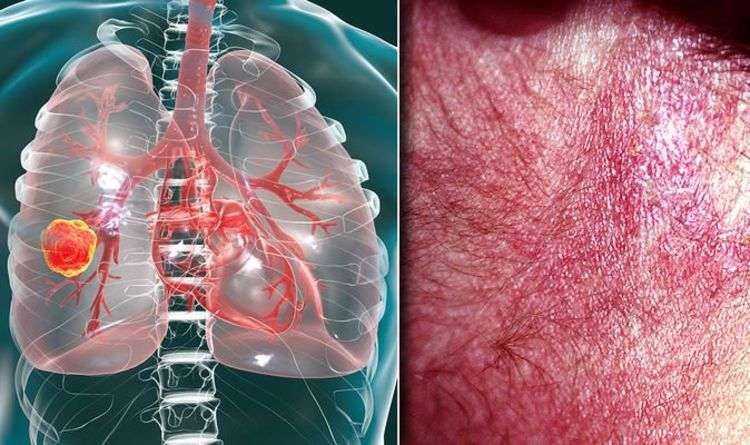 Lung cancer symptoms: Signs of tumour include itchy skin rash pain ...